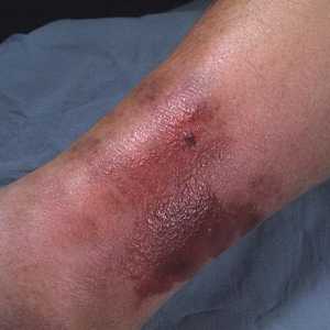 Erysipelas noge: Simptomi i tretman