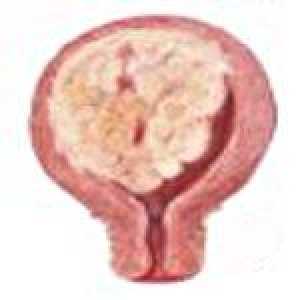 Sarkoma uterusa