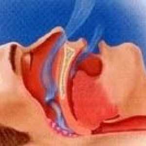 Sleep apnea sindrom