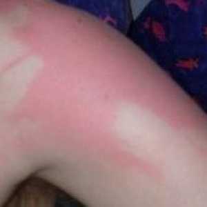 Sunburn (photodermatitis)