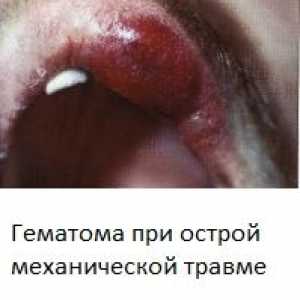 Stomatitis (upala usne šupljine) sa fotografijama