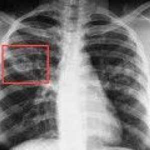 Plućne tuberkuloze