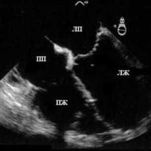 Ultrazvuk srca (ehokardiografija)