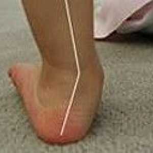 Valgus deformiteta stopala kod djece