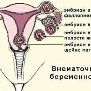Vanmaterične trudnoće
