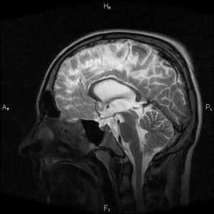 Interna mozak hidrocefalus