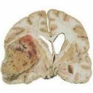 Intracerebralno tumora mozga hemisfere