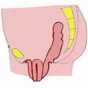 Prolaps maternice i vagine