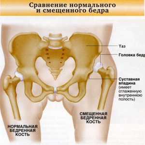 Hip dislokacija. Simptomi i tretman urođenih dislokacije kuka kod djece