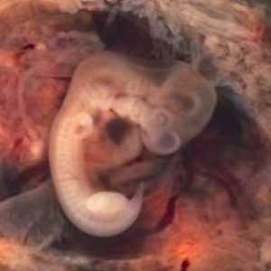 Neodrživih ili ne-razvoja trudnoće