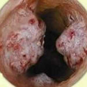 Malignih tumora dušnik
